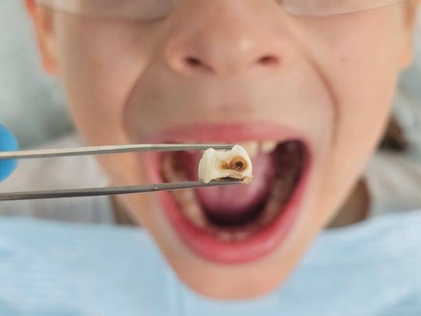 Best Emergency Dentist for Lost Fillings or Crowns in Mount Sinai, NY